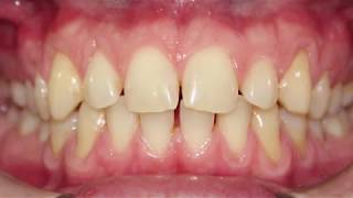 DSD FIRSTFIT VENEERS TECH AND CLINICAL