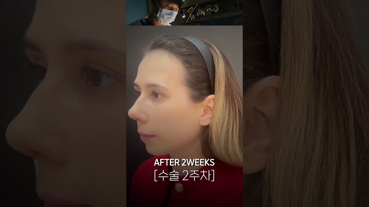 [Бэригүд гоо сайхны мэс заслын эмнэлэг] Шувуун хамартай хүмүүс ээ, энд цуглараарай! | Төгс хамрын хэлбэрийг бүтээх нь 💖 #Шувуун_хамар #Хамарны_гоо_сайхны_мэс_засал #Хамарны_мэс_засал