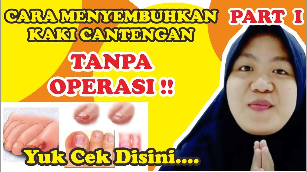 CARA MENYEMBUHKAN KUKU KAKI CANTENGAN KEKEONGEUN TANPA OPERASI PART I