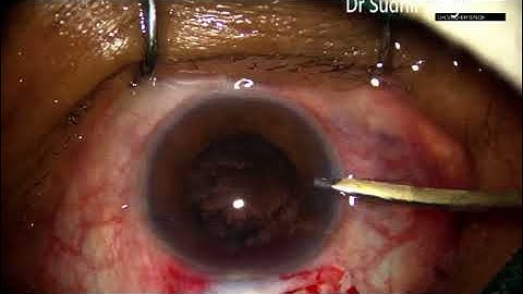 Safe Irrigation Aspiration BY Simcoe  Cannula