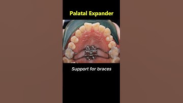 Amazing braces - Palatal expander orthodontics #dentist #braces