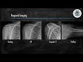 Proximal Humerus Fracture