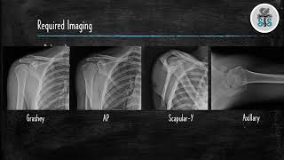 Proximal Humerus Fracture