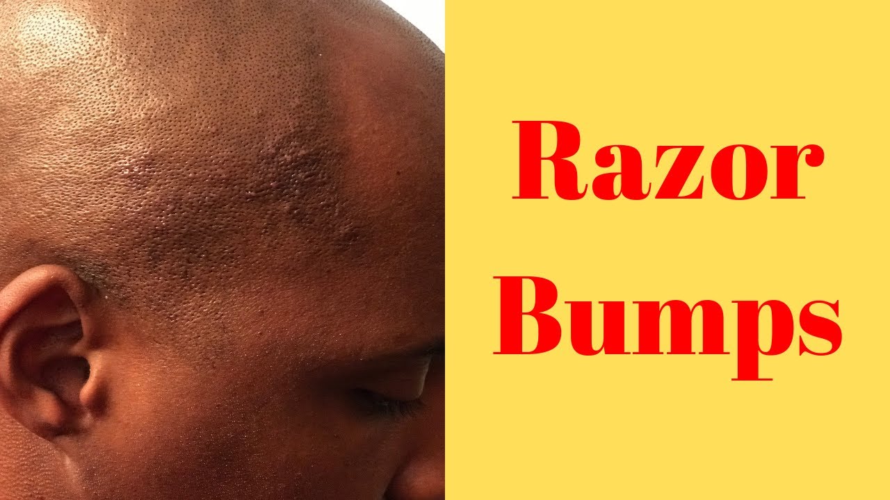 My Razor Bumps Got Worse - YouTube
