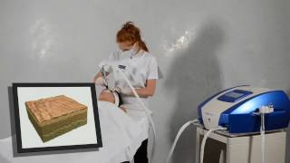 Well Étage Präsentiert 3D Skin Rejuvenation Mit Dem Mesotherm By Biotec Italia