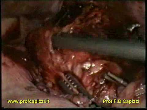 Adenoma del surrene asportazione del surrene