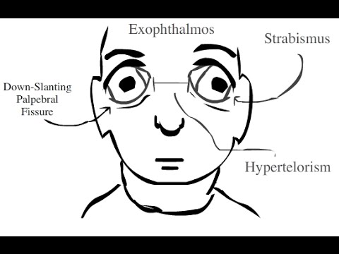 Apert Syndrome