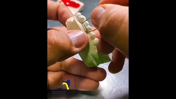 Adams Clasp Fabrication in Removable Appliance#orthodontics #Adamsclasp#removable_appliance#dentist