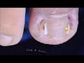 Cut Dirty Ingrown Toenail 剪大脏向内生长脚趾甲 #shorts #video #health
