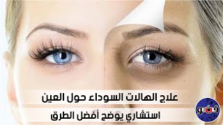 علاج الهالات السوداء حول العين.. استشاري يوضح أفضل الطرق
