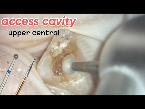 Upper Central  Access Cavity preparation