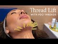 My PDO Thread Lift with Vanessa Lee at The Things We Do!