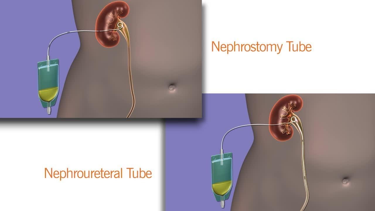 Laparoscopy-guided percutaneous cholecysfostomy