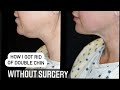 DOUBLE CHIN ~ KYBELLA vs  LIPOSUCTION  ~ WE DID BOTH!!!  Must WATCH!