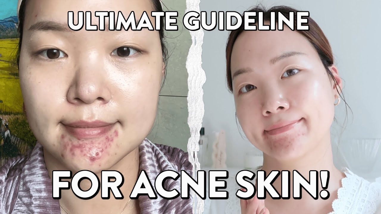 Best skincare for acne skin? Do acne spot treatments really work