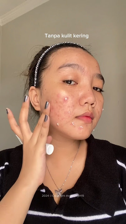 BYE JERAWAT MENDEM || ACNE CURE ACNAWAY STUBBORN