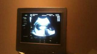 Jeremy and Natalie February 24, 2010 Sonogram Part 2