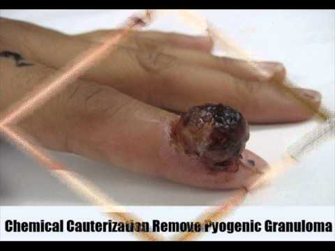 Natural Remedies For Pyogenic Granuloma Natural Remedies For Pyogenic Granuloma