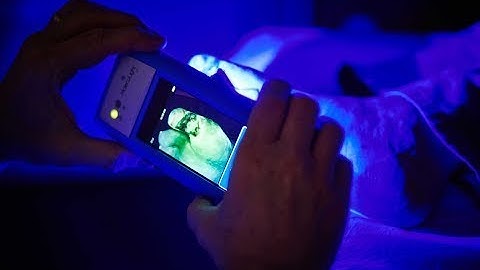 The MolecuLight i:X Wound Care Device in Action