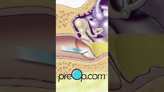 Preop Myringotomy Insertion Of Tube Must-Know Patient Info