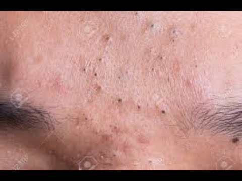 Relax with good videos on getting rid of acne (204) | Loan Nguyen