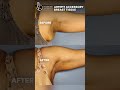 Before And After Results Of Axillary Breast Tissue Removal Dr Karishma Aesthetics Before And After Results Of Axillary Breast Tissue Removal Dr Karishma Aesthetics