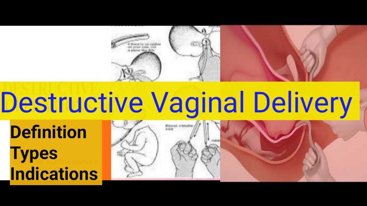 Destructive Operations/abnormal labour destructive vaginal delivery ...