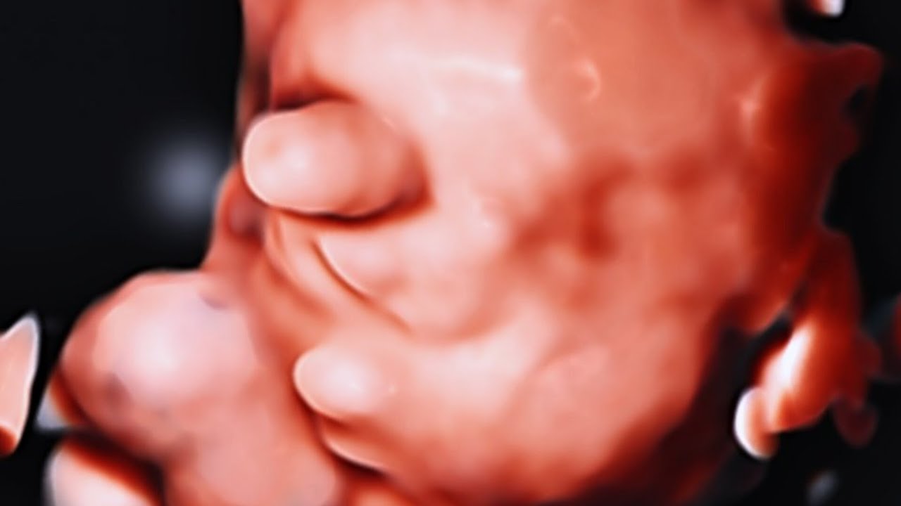 Cyclopia and proboscis fetal ultrasound with holoprosencephaly 