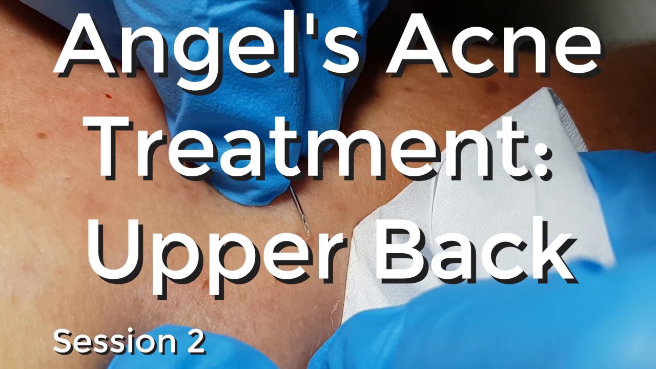 Angel's Acne treatment Upper Back Session II YouTube