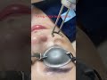 Toning = laser pico second