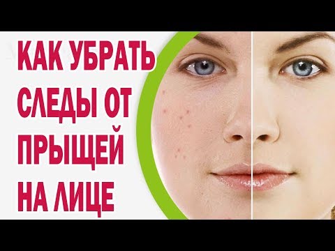 Удаляем следы от прыщей навсегда
