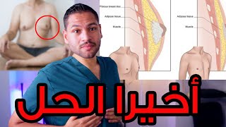 علاج التثدي عند الرجال في خطوتين فقط | gynecomastia