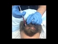 PRP Platelet Rich Plasma for Hair Loss and Hair Thinning. LA FUE Hair Clinic on How PRP is performed