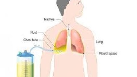 Thoracostomy CPT code - simplify medical coding