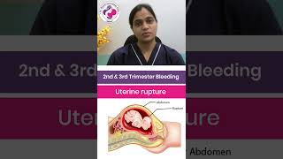 Detalles Is Uterine Rupture, Vasa Previa & Labor Causing Your Bleeding During Pregnancy By Dr Mayuri’s Guide Actualización