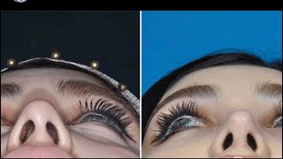 دكتور مهدي رمضاني عملية تجميل الانف / صور قبل وبعد من غرفة عمليات 00989398297154 whtsapp