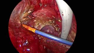 VATS converted to VAMT (Video assisted Mini Thoracotomy) radical excision of mediastinal tumor.