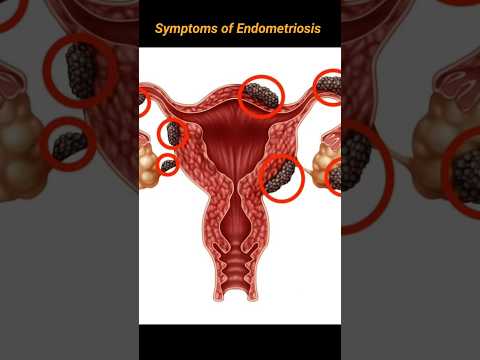 Endometriosis symptoms #shorts