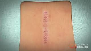 Removing Herniated Disk (Surgery Animation)