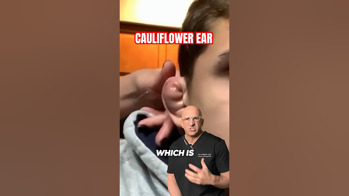 Dead Cartilage or Mark of Distinction⁉️ Cauliflower Ear #shorts