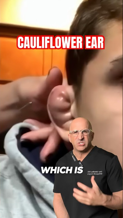 Dead Cartilage or Mark of Distinction⁉️ Cauliflower Ear #shorts