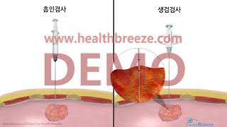 [시연용]b0297aako_CT유도하 경피적 세침흡인 및 폐생검 검사 안내(PCNA Bx)