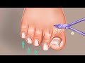 ASMR Toe Nail Operation | @SatisfyingASMRanimations