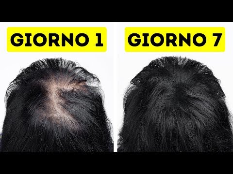 Video: Cipolle E Vodka Rendono I Capelli Folti