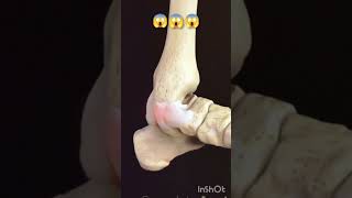Shoulder Arthroplasty (with osseointegration) | Procedures