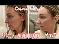 THE COSMELAN PEEL | MY FIRST CHEMICAL PEEL | DIARY FROM APPLICATION TO DAY 30