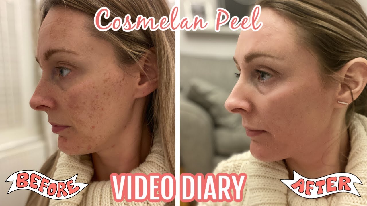 THE COSMELAN PEEL MY FIRST CHEMICAL PEEL DIARY FROM APPLICATION TO DAY 30 YouTube THE COSMELAN PEEL MY FIRST CHEMICAL PEEL DIARY FROM APPLICATION TO DAY 30 YouTube