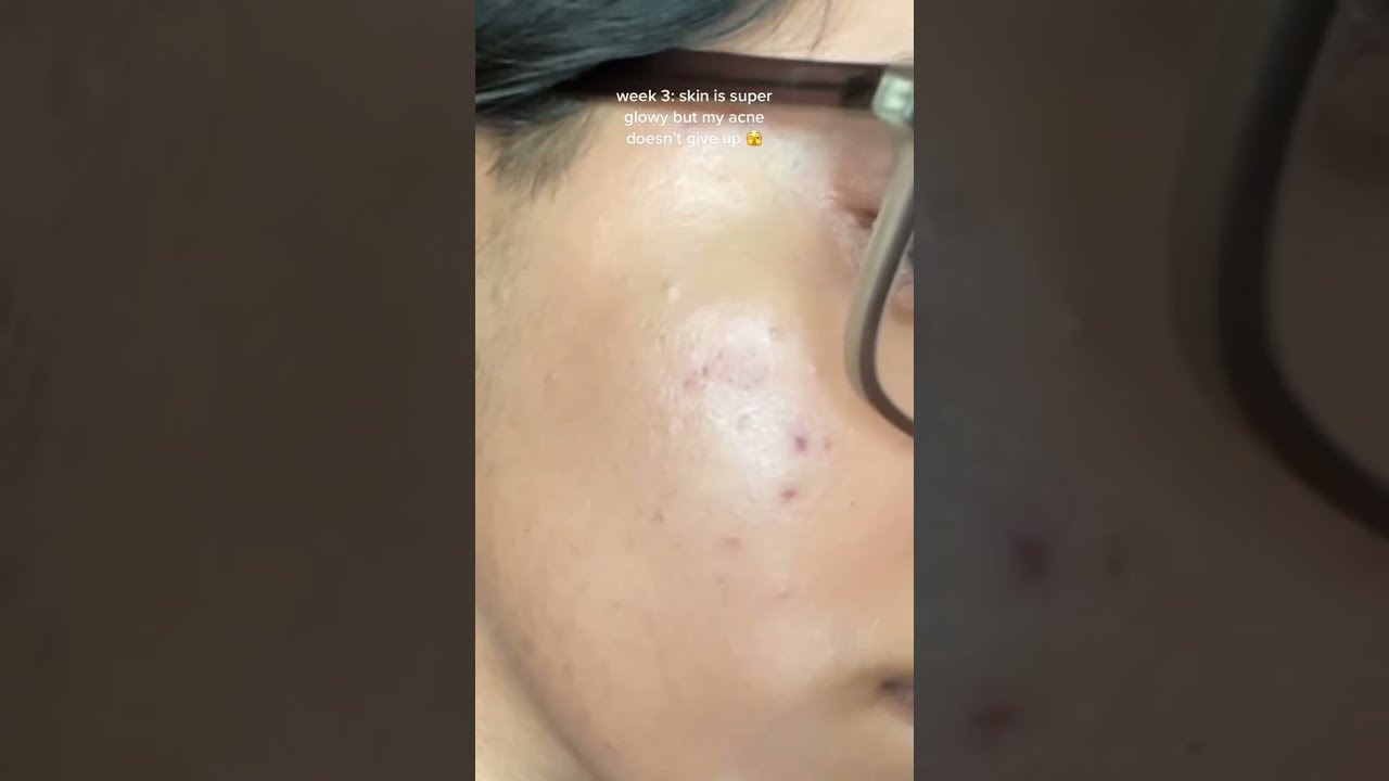 My 1 Month Tretinoin Progress With Acne Prone Skin 