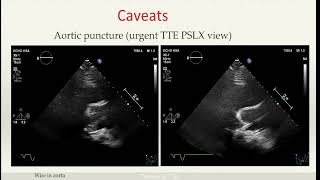 Transoesophageal echocardiography step-by-step procedural guidance for mitral valve TEER