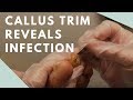 Callus Trim Reveals Infection